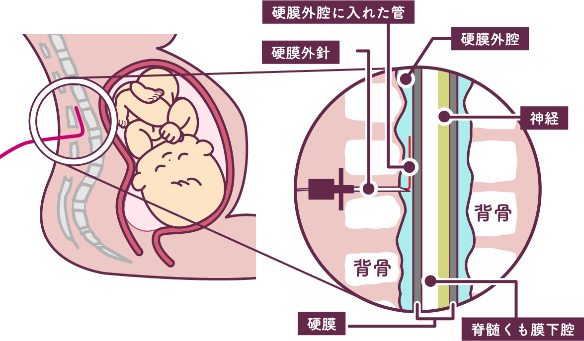 無痛分娩イラスト